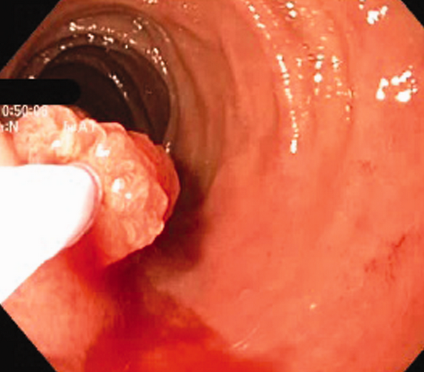 Preservation of the mucosa is evident, with mildly hypertrophic appearance of the muscularis mucosae (Courtesy Dr. V. Penopoulos)