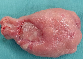 Infiltration of the submucosal layer with granulation tissue (Courtesy Dr. V. Penopoulos)
