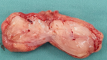 Immunohistochemical staining with anti-CD117 antibody – Positive expression in mast cells and negative expression in elongated spindle cells (Courtesy Dr. V. Penopoulos)
