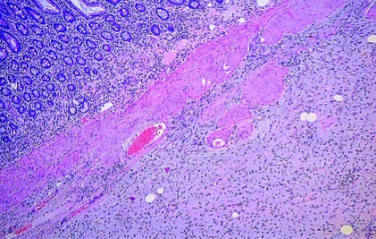 Immunohistochemical staining with anti-CD117 antibody – Positive expression in mast cells and negative expression in elongated spindle cells (Courtesy Dr. V. Penopoulos)