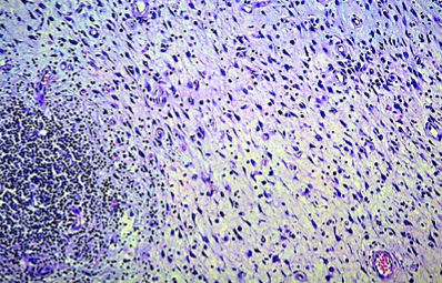 Immunohistochemical staining with anti-CD117 antibody – Positive expression in mast cells and negative expression in elongated spindle cells (Courtesy Dr. V. Penopoulos)