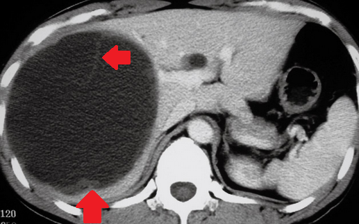 Abdominal CT scan. Hemorrhagic rupture of a simple hepatic cyst without active hemorrhage. The presence of free intraperitoneal fluid is noted (Courtesy Dr. V. Penopoulos)