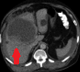 Abdominal CT scan. Hemorrhagic rupture of a simple hepatic cyst without active hemorrhage. The presence of free intraperitoneal fluid is noted (Courtesy Dr. V. Penopoulos)