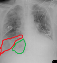 CT κοιλίας. Κόκκινο βέλος – Παγκρεατίτιδα – Περιπαγκρεατική συλλογή στον σπληνονεφρικό χώρο (Ευγενική παραχώρηση Dr. V. Penopoulos)
