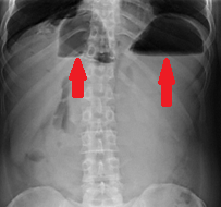 CT κοιλίας. Κόκκινο βέλος – Παγκρεατίτιδα – Περιπαγκρεατική συλλογή στον σπληνονεφρικό χώρο (Ευγενική παραχώρηση Dr. V. Penopoulos)
