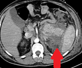 CT θώρακος-κοιλίας. Κήλη Bochdalek (Ευγενική παραχώρηση Dr. V. Penopoulos)