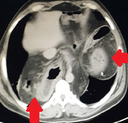 Διάφορα στάδια αναγνώρισης και αποκατάστασης της κήλης (Ευγενική παραχώρηση Dr. V. Penopoulos)
