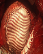 Μεταεγχειρητική ακτινοσκόπηση με gastrografin. Στομάχι σε φυσιολογική θέση μετά γαστροπηξία (Ευγενική παραχώρηση Dr. V. Penopoulos)