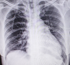 Μεταεγχειρητική ακτινοσκόπηση με gastrografin. Στομάχι σε φυσιολογική θέση μετά γαστροπηξία (Ευγενική παραχώρηση Dr. V. Penopoulos)