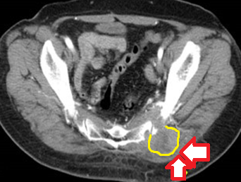 Χρώση αιματοξυλίνης-ηωσίνης. Διάχυτη διήθηση από μεγάλα άτυπα λεμφοειδή κύτταρα με εμφανή πυρηνίσκο (Ευγενική παραχώρηση Dr. V. Penopoulos)