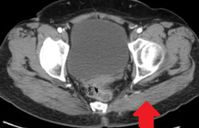 Η διάβρωση της ιερολαγόνιας άρθρωσης επέμεινε, αποδεικνύοντας τον καταστροφικό χαρακτήρα του νεοπλάσματος (Ευγενική παραχώρηση Dr. V. Penopoulos)
