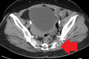 Η διάβρωση της ιερολαγόνιας άρθρωσης επέμεινε, αποδεικνύοντας τον καταστροφικό χαρακτήρα του νεοπλάσματος (Ευγενική παραχώρηση Dr. V. Penopoulos)