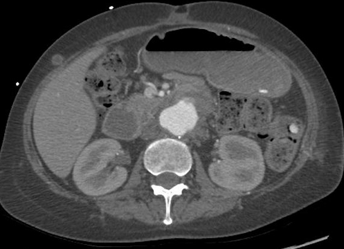 Abdominal CT scan. Distended small bowel loops with fluid content (Courtesy Dr. V. Penopoulos)
