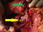 Anatomical forceps within the fistula orifice in the duodenum (Courtesy Dr. V. Penopoulos)