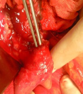 Anatomical forceps within the fistula orifice in the duodenum (Courtesy Dr. V. Penopoulos)