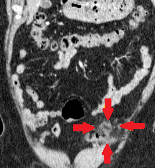 CT κοιλίας. Κόκκινα βέλη – Φλεγμαίνον επίπλοϊκό εξάρτημα με υπέρπυκνο περιφερικό περίβλημα (Ευγενική παραχώρηση Dr. V. Penopoulos)