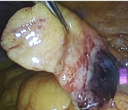 Διαγνωστική λαπαροσκόπηση. Φλεγμαίνον επίπλοϊκό εξάρτημα (Ευγενική παραχώρηση Dr. V. Penopoulos)