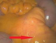 Μεσεντερική παννικουλίτιδα (Ευγενική παραχώρηση Dr. V. Penopoulos)