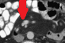 Ψευδοόγκος ρίζας μεσεντερίου – Μεσεντερική παννικουλίτιδα (Ευγενική παραχώρηση Dr. V. Penopoulos)