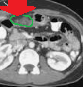 Έμφρακτο επιπλόου (Ευγενική παραχώρηση Dr. V. Penopoulos)