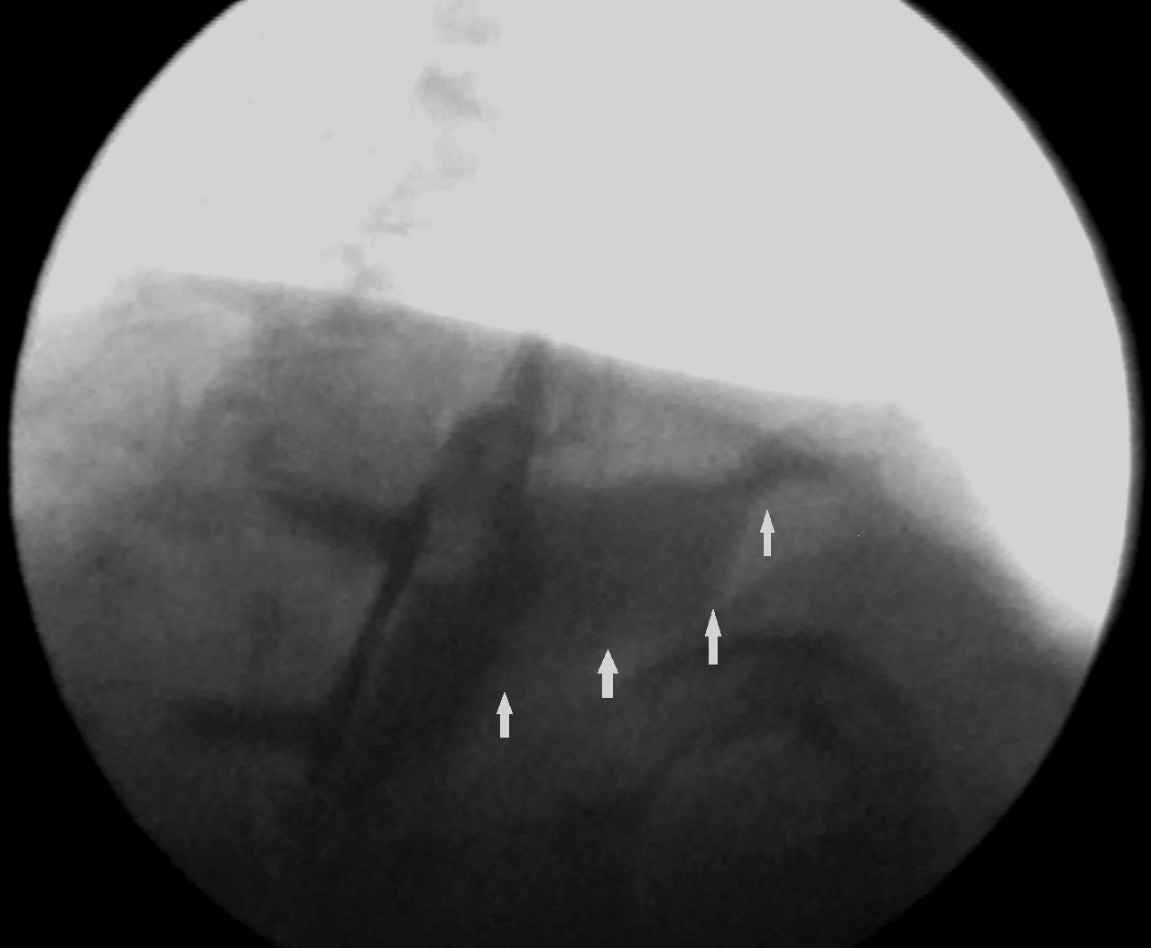 White arrows indicate the leak from the posterior esophageal wall (Courtesy Dr. V. Penopoulos)