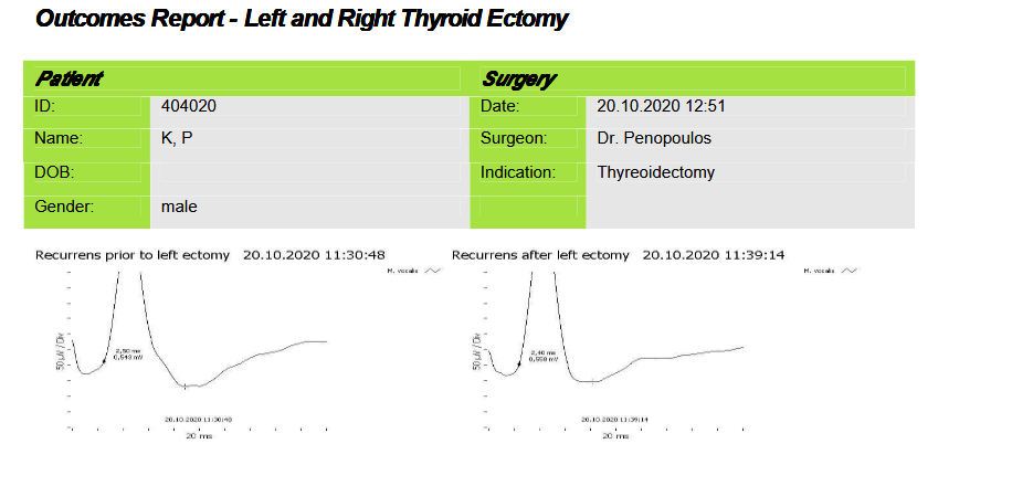 Recordings of the left recurrent laryngeal nerve potentials, before and after removal of the left thyroid lobe (Courtesy Dr. V. Penopoulos)
