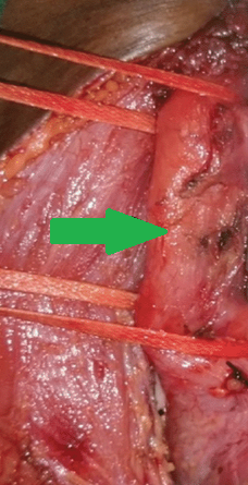 Complete mobilization of the upper esophagus and encirclement with Penrose drains (Courtesy Dr. V. Penopoulos)