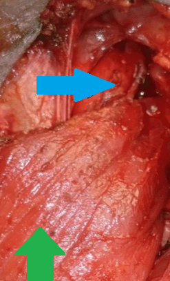 Green arrow: Sternocleidomastoid muscle. Blue arrow: Esophagus (Courtesy Dr. V. Penopoulos)