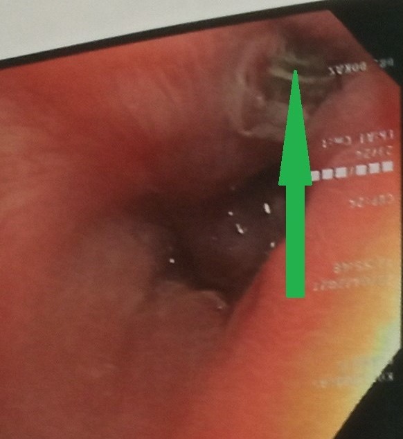Esophagoscopy. Green arrow: Esophageal pseudodiverticulum (Courtesy Dr. V. Penopoulos)