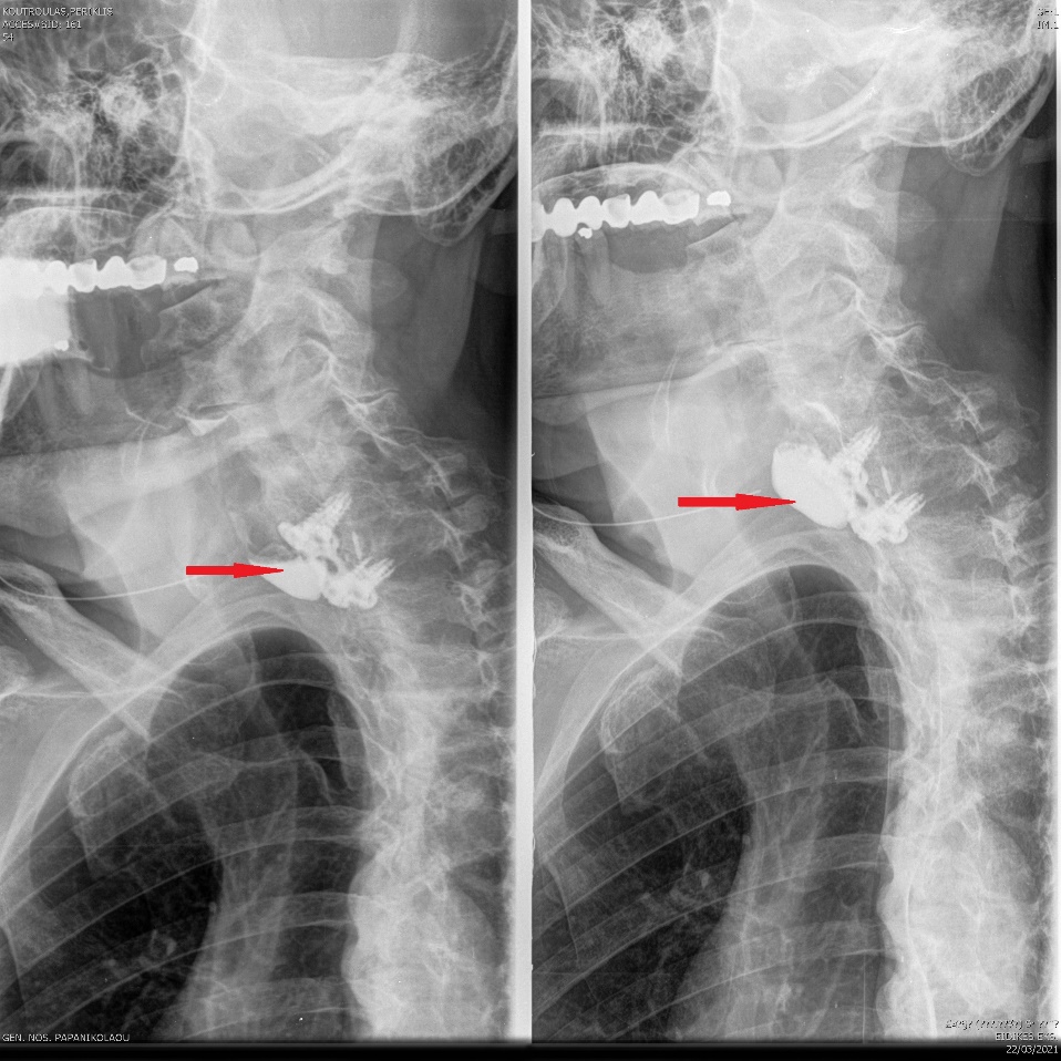 Esophagography. Arrows demonstrate a small posterior pseudodiverticulum of the esophagus adjacent to the metallic plate and screws (Courtesy Dr. V. Penopoulos)