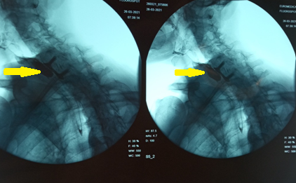 Esophagography. Arrows demonstrate a small posterior pseudodiverticulum of the esophagus adjacent to the metallic plate and screws (Courtesy Dr. V. Penopoulos)