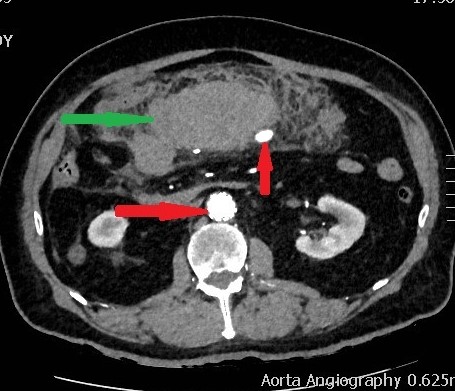 Αγγειογραφία μετά εμβολισμό της αρτηρίας πλησίον του άπω άκρου του ψευδοανευρύσματος στο αρτηριακό τόξο του Riolan, που αποδεικνύει τα σπειράματα σε σωστή θέση. Απεικονίστηκαν οι σιγμοειδείς και η άνω ορθική αρτηρία, ενώ το ψευδοανεύρυσμα δεν ήταν ορατό (Ευγενική παραχώρηση Dr. V. Penopoulos)