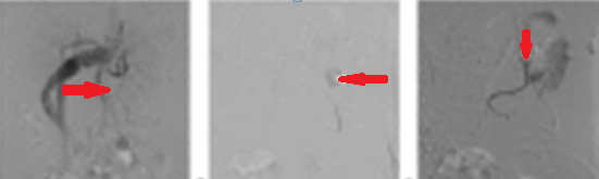 Αγγειογραφία μετά εμβολισμό της αρτηρίας πλησίον του άπω άκρου του ψευδοανευρύσματος στο αρτηριακό τόξο του Riolan, που αποδεικνύει τα σπειράματα σε σωστή θέση. Απεικονίστηκαν οι σιγμοειδείς και η άνω ορθική αρτηρία, ενώ το ψευδοανεύρυσμα δεν ήταν ορατό (Ευγενική παραχώρηση Dr. V. Penopoulos)