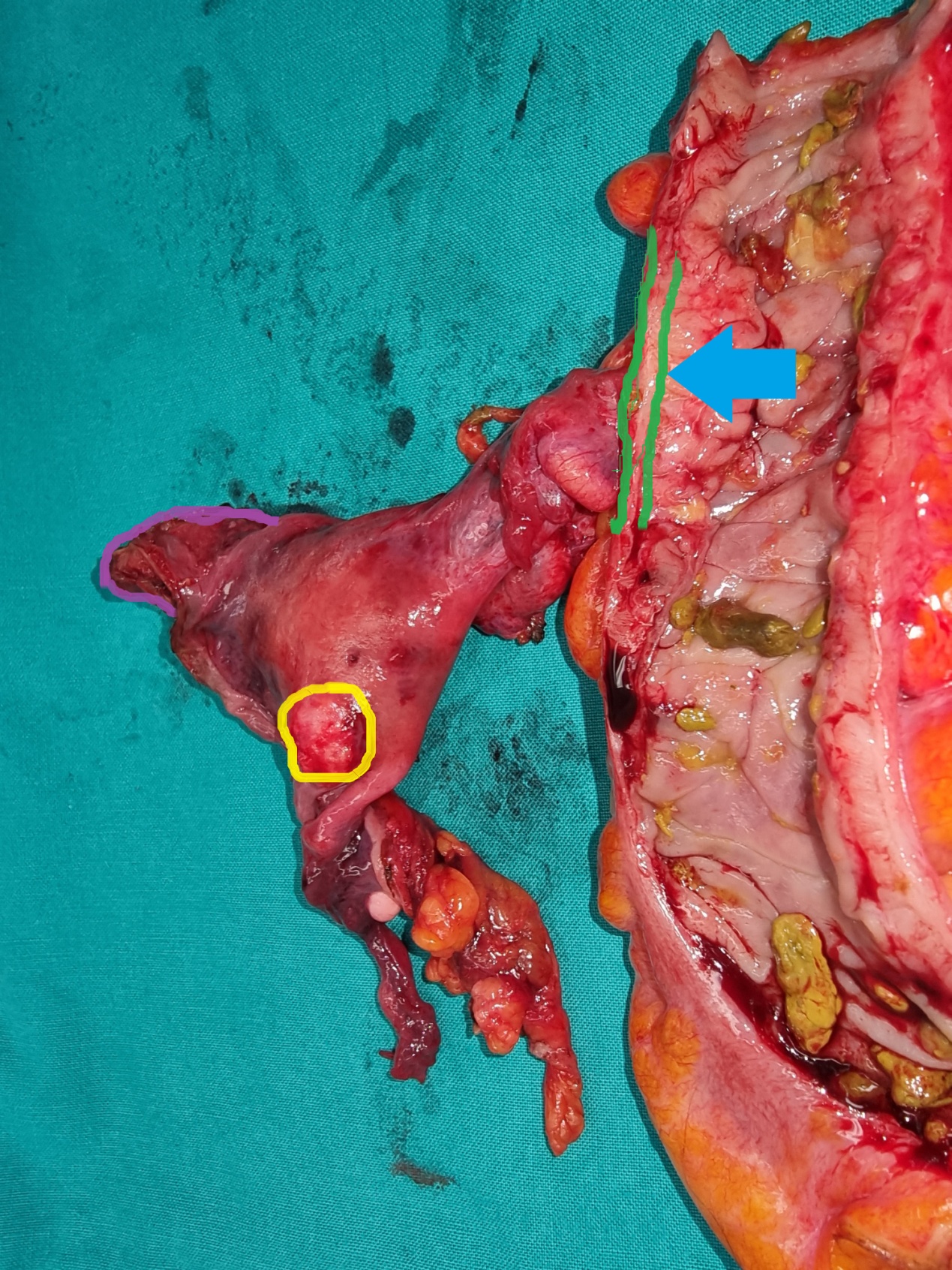 En bloc ορθοσιγμοειδεκτομή συν ολική υστερεκτομία. Μπλε βέλος: Ουτερο-κολικό συρίγγιο. Κίτρινος κύκλος: Ινομύωμα μήτρας (Ευγενική παραχώρηση Dr. V. Penopoulos).