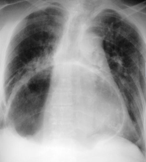 Organoaxial gastric volvulus (Courtesy Dr. V. Penopoulos)