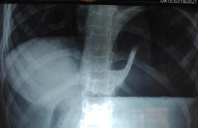 Organoaxial gastric volvulus (Courtesy Dr. V. Penopoulos)