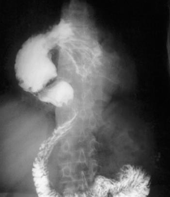Organoaxial gastric volvulus (Courtesy Dr. V. Penopoulos)