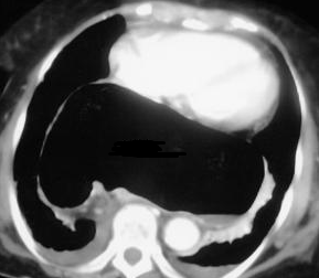 Organoaxial gastric volvulus (Courtesy Dr. V. Penopoulos)