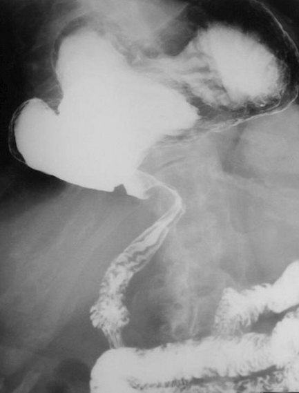 Organoaxial gastric volvulus (Courtesy Dr. V. Penopoulos)