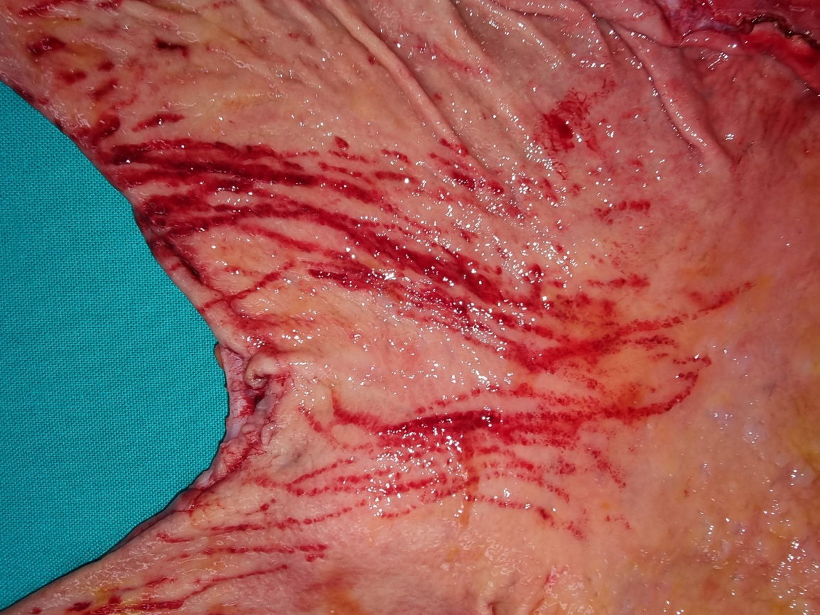 Detail of the lesser curvature of the stomach. Early ischemic changes (Courtesy Dr. V. Penopoulos)