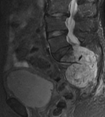 Enlargement of the chordoma with erosion of the sacrum (Courtesy Dr. V. Penopoulos)