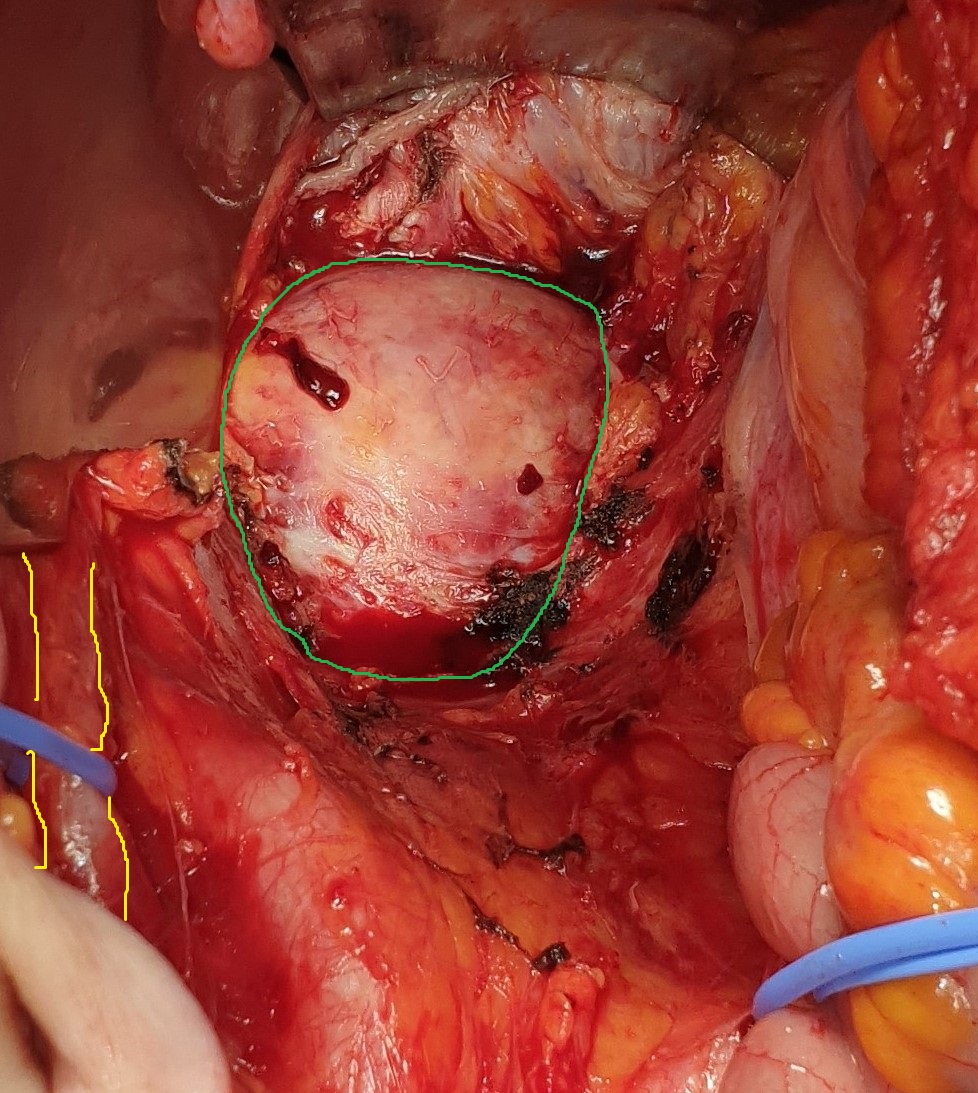Evident dilation of the left ureter -- yellow outline. Green outline -- Chordoma (Courtesy Dr. V. Penopoulos)