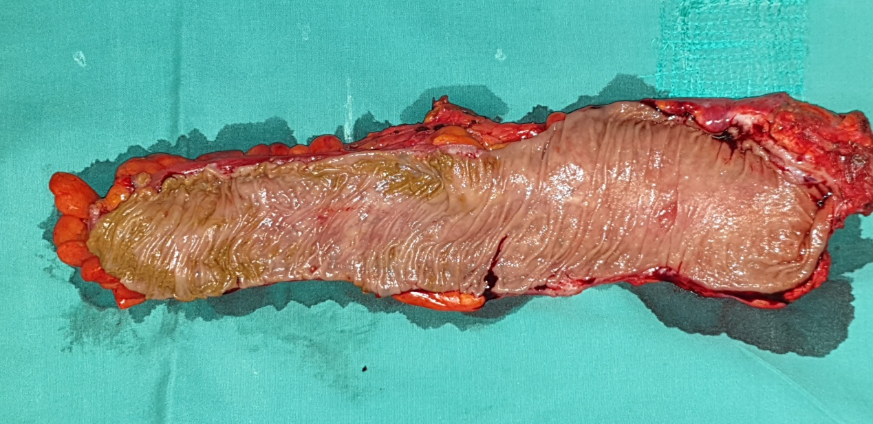 Resected rectum and portion of the sigmoid (Courtesy Dr. V. Penopoulos)