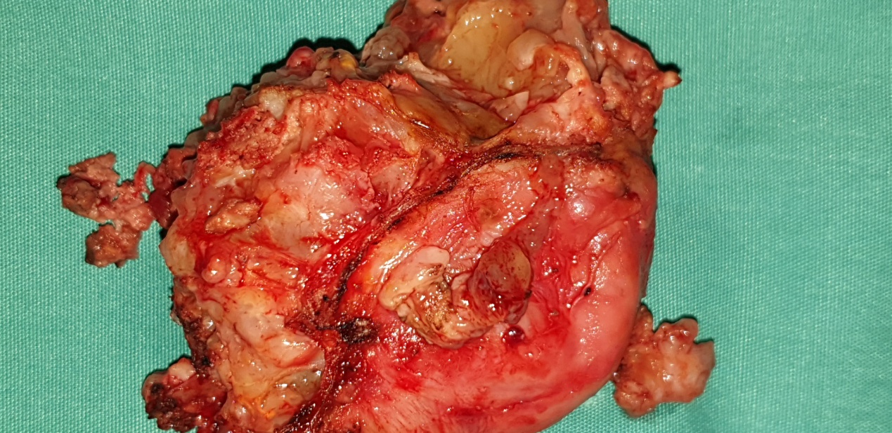 Completely excised chordoma (Courtesy Dr. V. Penopoulos)