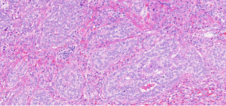 Ανοσοϊστοχημική εξέταση θετική για συναπτοφυσίνη (Ευγενική παραχώρηση Dr. V. Penopoulos)