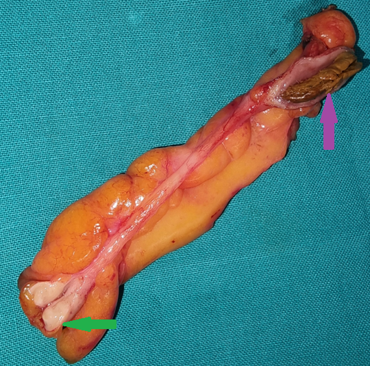 Ανοσοϊστοχημική εξέταση θετική για Ki-67 (Ευγενική παραχώρηση Dr. V. Penopoulos)