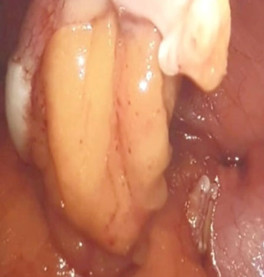 Ανοσοϊστοχημική εξέταση θετική για Ki-67 (Ευγενική παραχώρηση Dr. V. Penopoulos)