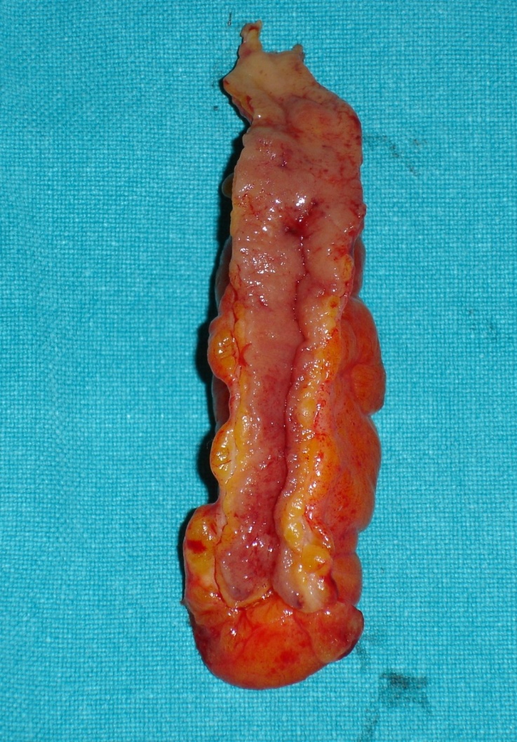 Ανοσοϊστοχημική εξέταση θετική για Ki-67 (Ευγενική παραχώρηση Dr. V. Penopoulos)