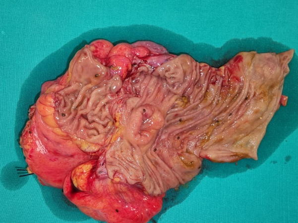 Ανοσοϊστοχημική εξέταση θετική για Ki-67 (Ευγενική παραχώρηση Dr. V. Penopoulos)