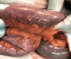 Bezoar within an ileal loop (Courtesy Dr. V. Penopoulos)